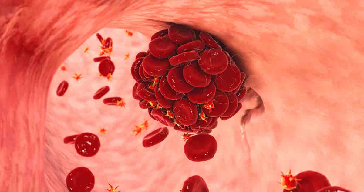 Trombofilije - Dijagnostika i lečenje - Hematologika